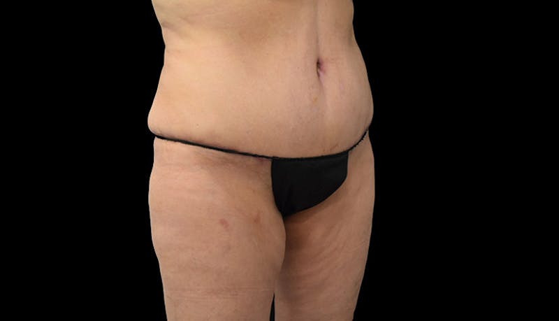 Massive Weight Loss Before & After Gallery - Patient 102449301 - Image 4