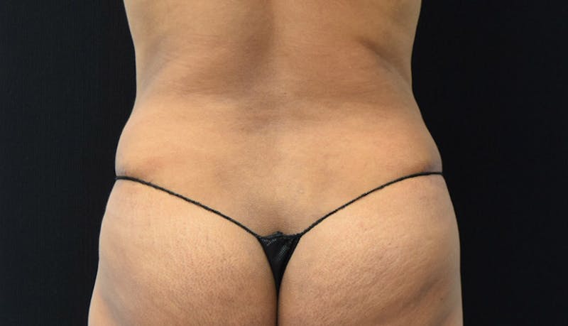 Abdominoplasty Before & After Gallery - Patient 102441588 - Image 12