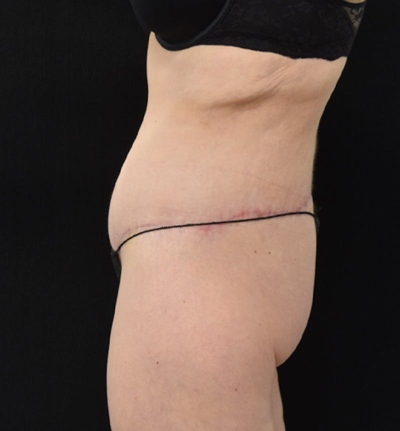 Lower Body Lift Before & After Gallery - Patient 102449303 - Image 6