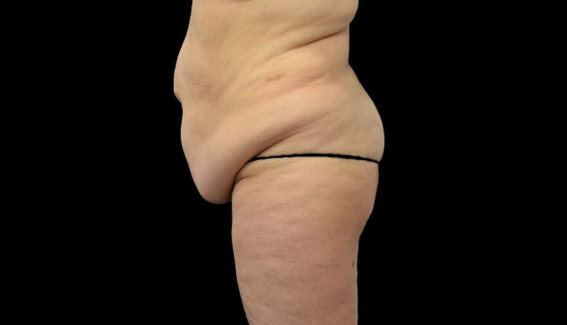 Massive Weight Loss Before & After Gallery - Patient 102449301 - Image 5