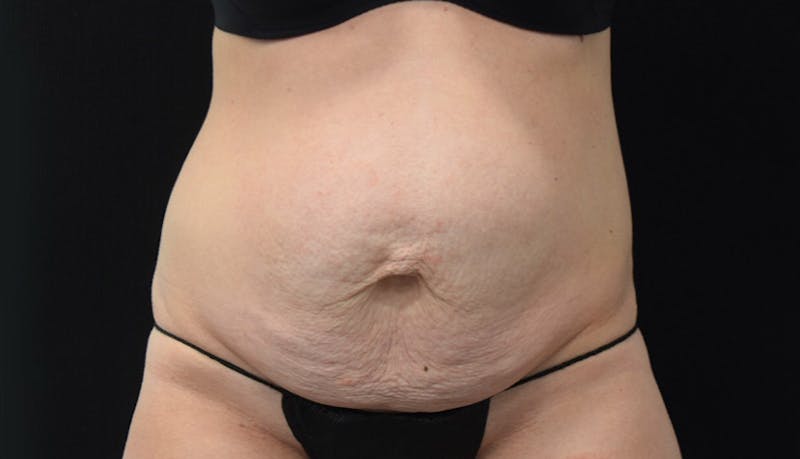 Abdominoplasty Before & After Gallery - Patient 102449309 - Image 1