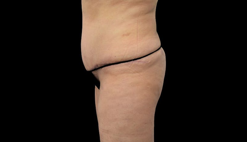 Massive Weight Loss Before & After Gallery - Patient 102449301 - Image 6
