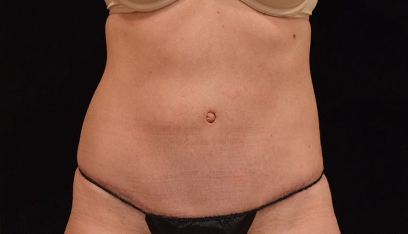 Abdominoplasty Before & After Gallery - Patient 102449309 - Image 2