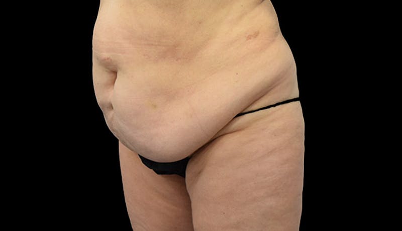 Massive Weight Loss Before & After Gallery - Patient 102449301 - Image 7