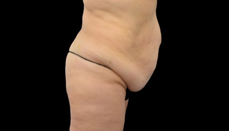 Massive Weight Loss Before & After Gallery - Patient 102449301 - Image 9