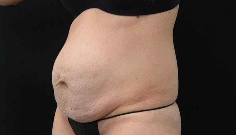 Abdominoplasty Before & After Gallery - Patient 102449309 - Image 3