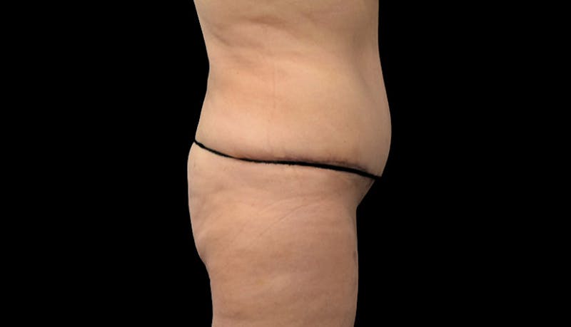 Massive Weight Loss Gallery - Patient 102449301 - Image 10