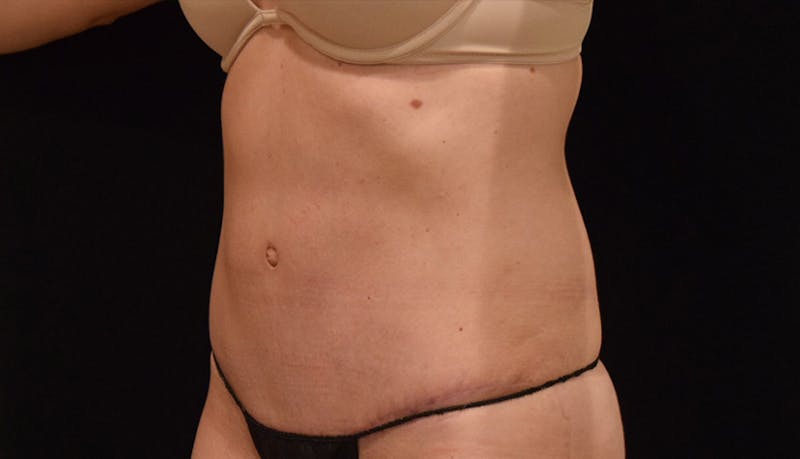 Abdominoplasty Before & After Gallery - Patient 102449309 - Image 4