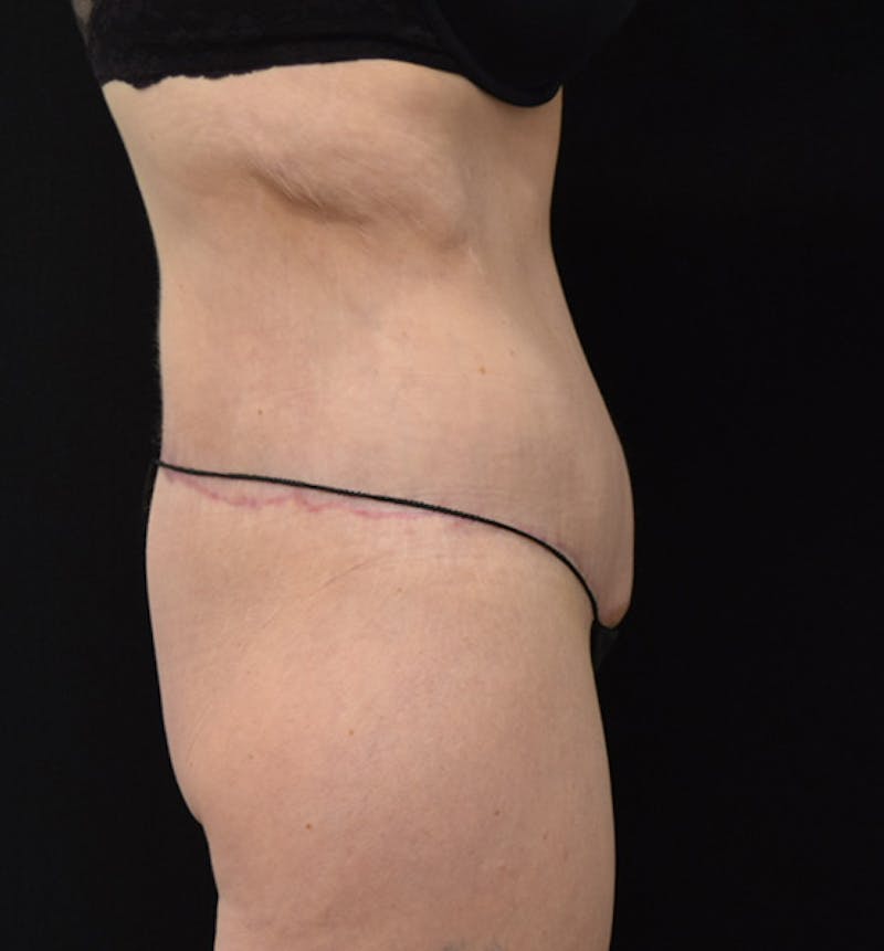 Lower Body Lift Before & After Gallery - Patient 102449303 - Image 8