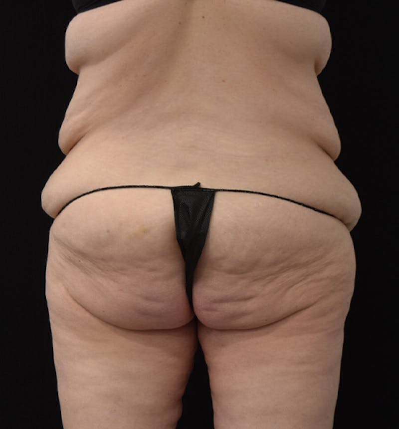 Lower Body Lift Before & After Gallery - Patient 102449303 - Image 9