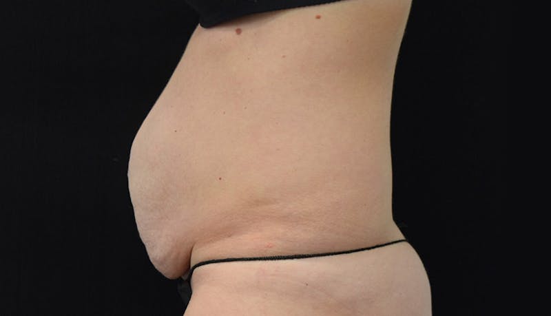 Abdominoplasty Before & After Gallery - Patient 102449309 - Image 5
