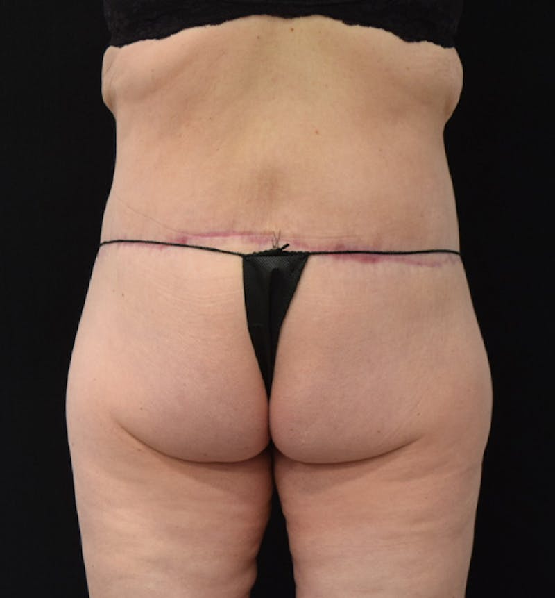 Lower Body Lift Before & After Gallery - Patient 102449303 - Image 10