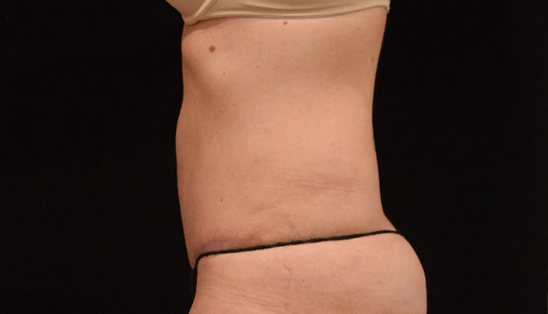 Abdominoplasty Before & After Gallery - Patient 102449309 - Image 6