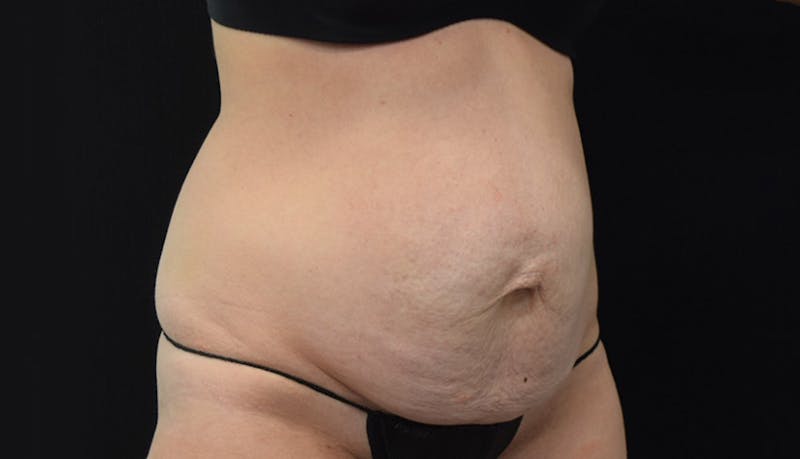 Abdominoplasty Before & After Gallery - Patient 102449309 - Image 7