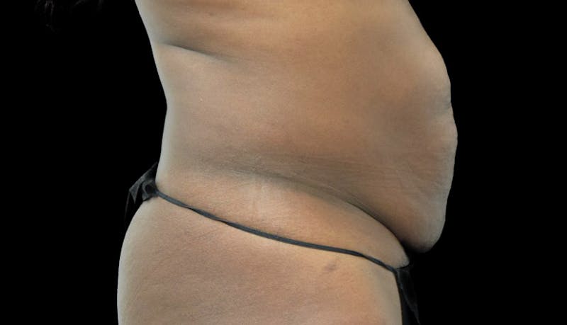 Massive Weight Loss Before & After Gallery - Patient 102449318 - Image 5