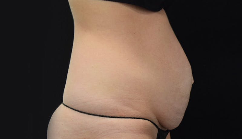 Abdominoplasty Before & After Gallery - Patient 102449309 - Image 9