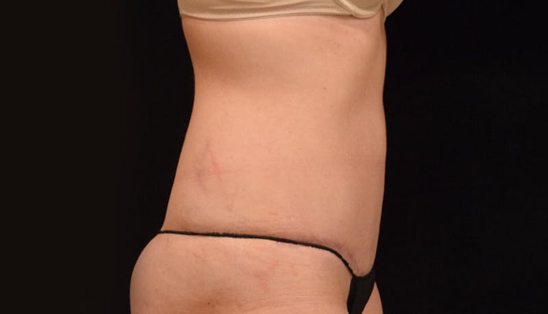 Abdominoplasty Before & After Gallery - Patient 102449309 - Image 10