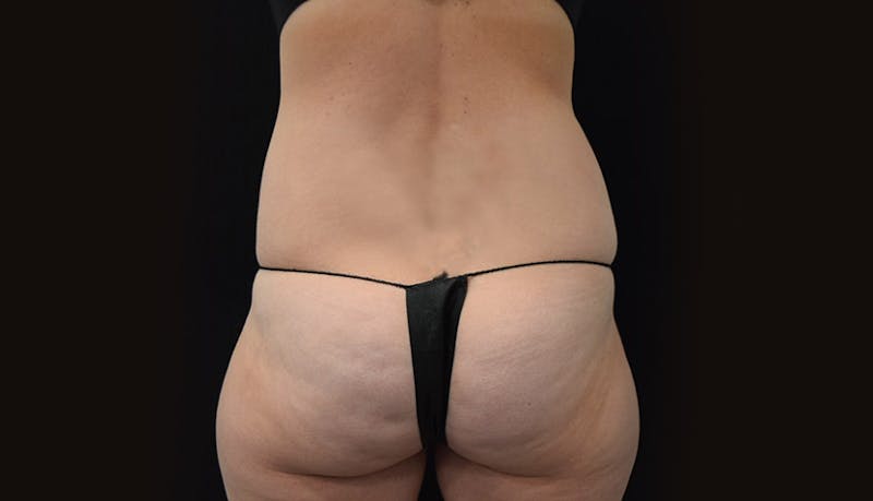 Abdominoplasty Before & After Gallery - Patient 102449309 - Image 11
