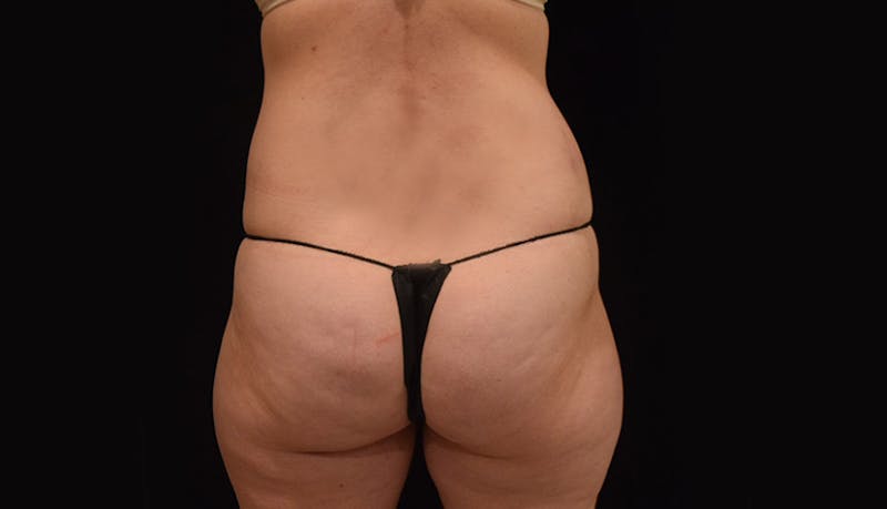Abdominoplasty Before & After Gallery - Patient 102449309 - Image 12