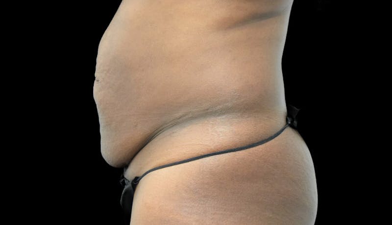 Massive Weight Loss Before & After Gallery - Patient 102449318 - Image 9