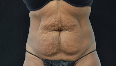 Abdominoplasty Before & After Gallery - Patient 102449339 - Image 1