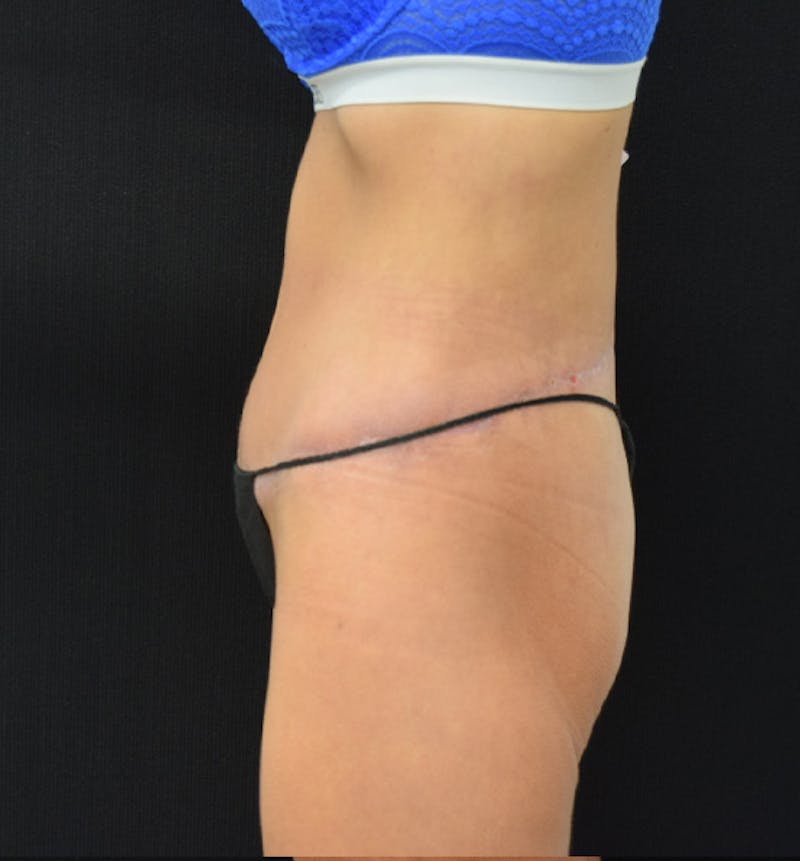 Lower Body Lift Before & After Gallery - Patient 102449350 - Image 6