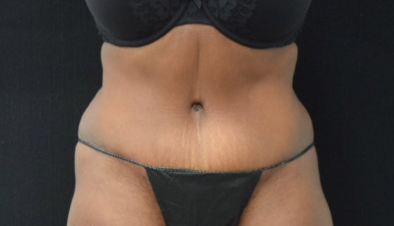 Abdominoplasty Before & After Gallery - Patient 102449339 - Image 2