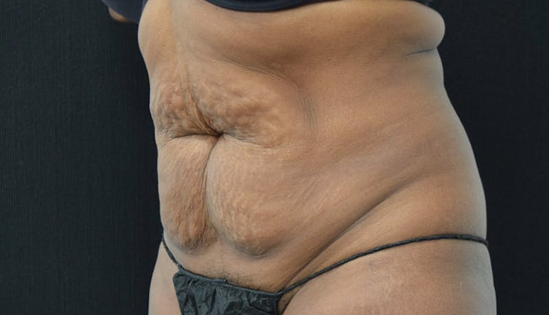 Abdominoplasty Before & After Gallery - Patient 102449339 - Image 3