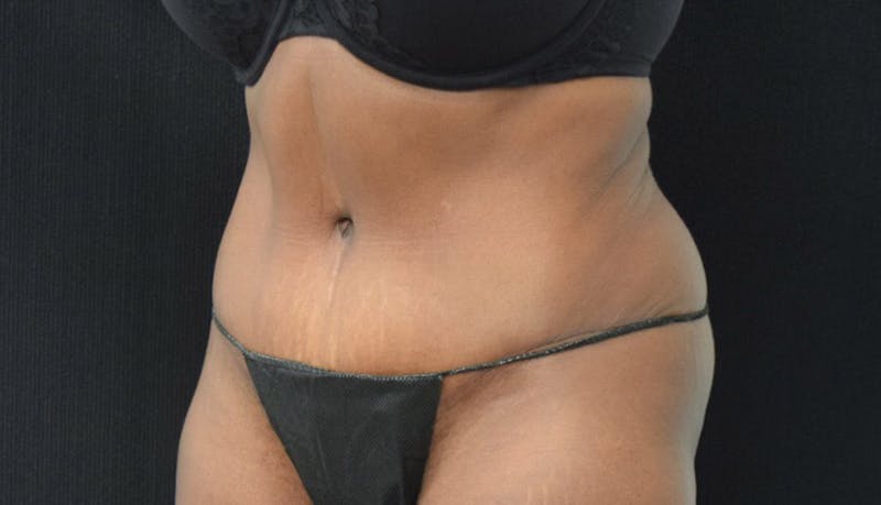 Abdominoplasty Before & After Gallery - Patient 102449339 - Image 4