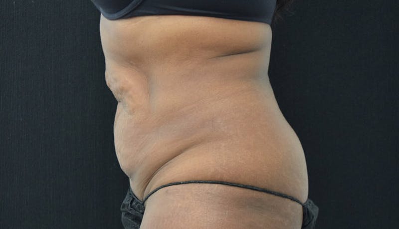Abdominoplasty Before & After Gallery - Patient 102449339 - Image 5