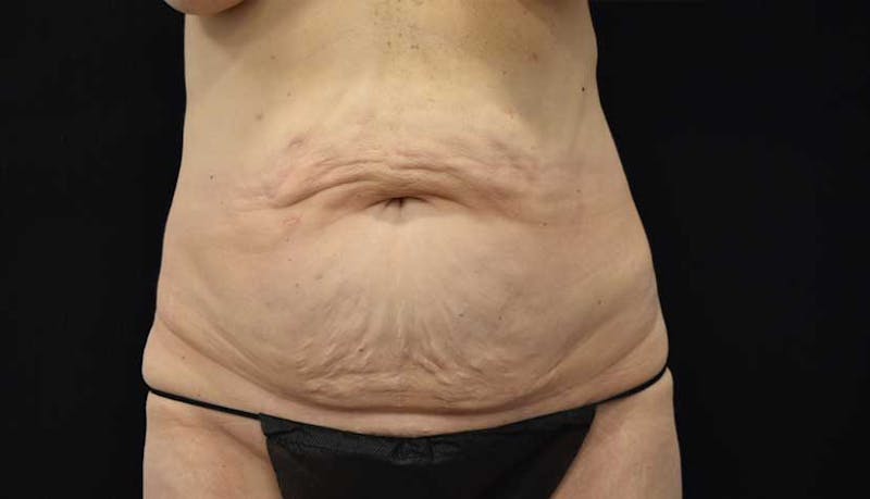 Massive Weight Loss Gallery - Patient 102449346 - Image 1