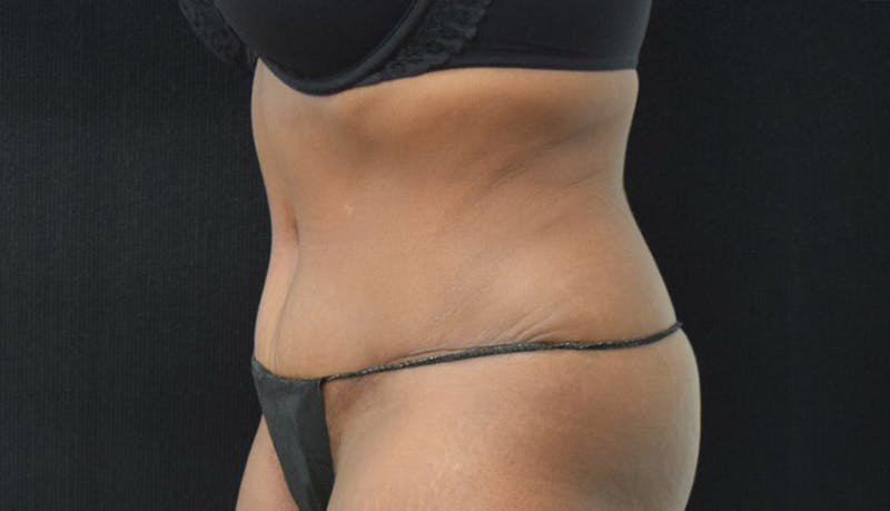 Abdominoplasty Before & After Gallery - Patient 102449339 - Image 6