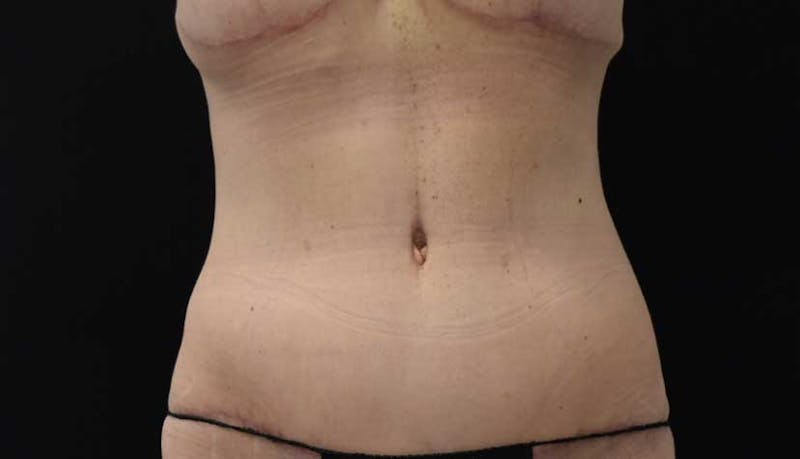Massive Weight Loss Gallery - Patient 102449346 - Image 2