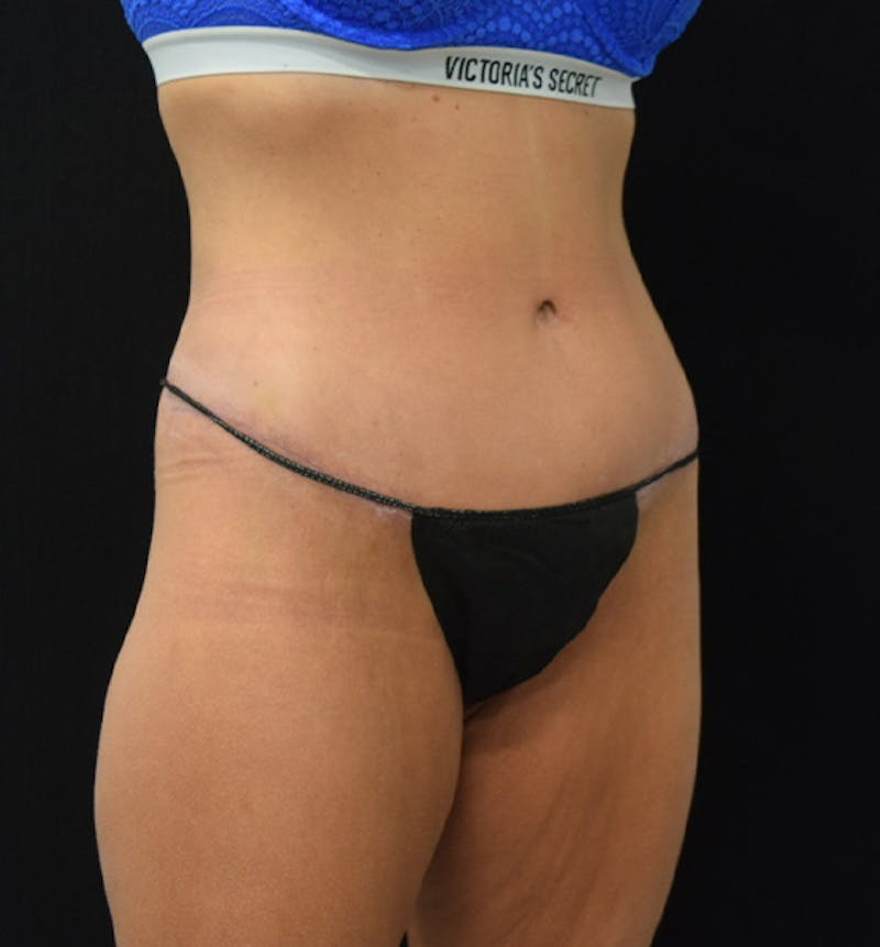 Lower Body Lift Before & After Gallery - Patient 102449350 - Image 8
