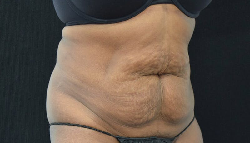 Abdominoplasty Before & After Gallery - Patient 102449339 - Image 7