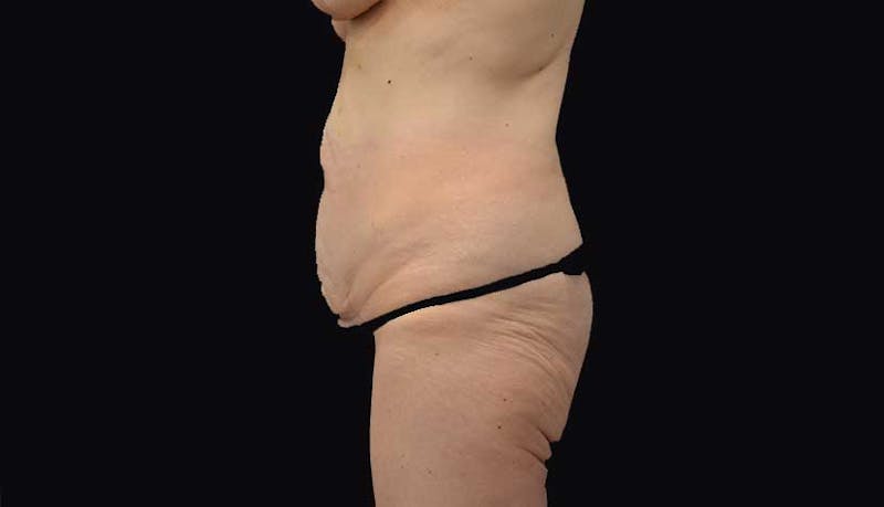 Massive Weight Loss Before & After Gallery - Patient 102449346 - Image 3
