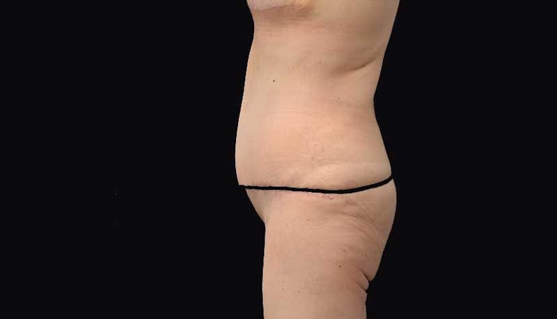 Massive Weight Loss Before & After Gallery - Patient 102449346 - Image 4