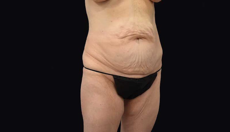 Massive Weight Loss Before & After Gallery - Patient 102449346 - Image 5