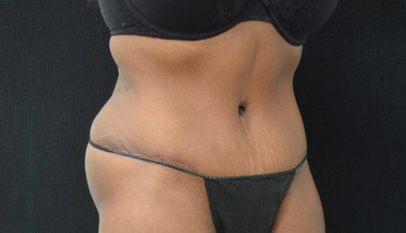 Abdominoplasty Before & After Gallery - Patient 102449339 - Image 8
