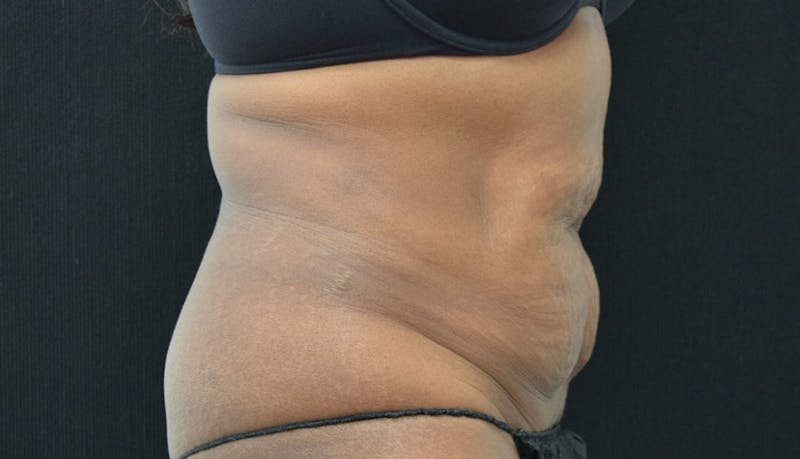 Abdominoplasty Before & After Gallery - Patient 102449339 - Image 9