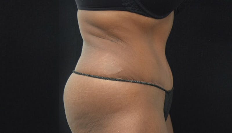 Abdominoplasty Before & After Gallery - Patient 102449339 - Image 10