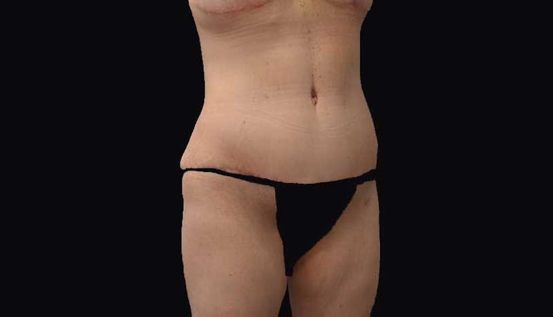Massive Weight Loss Before & After Gallery - Patient 102449346 - Image 6