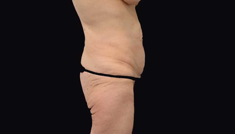 Massive Weight Loss Before & After Gallery - Patient 102449346 - Image 7