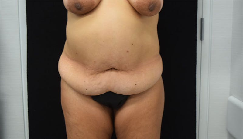 Abdominoplasty Before & After Gallery - Patient 102457120 - Image 1
