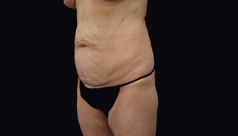 Massive Weight Loss Before & After Gallery - Patient 102449346 - Image 9