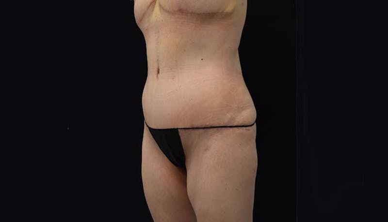 Massive Weight Loss Before & After Gallery - Patient 102449346 - Image 10
