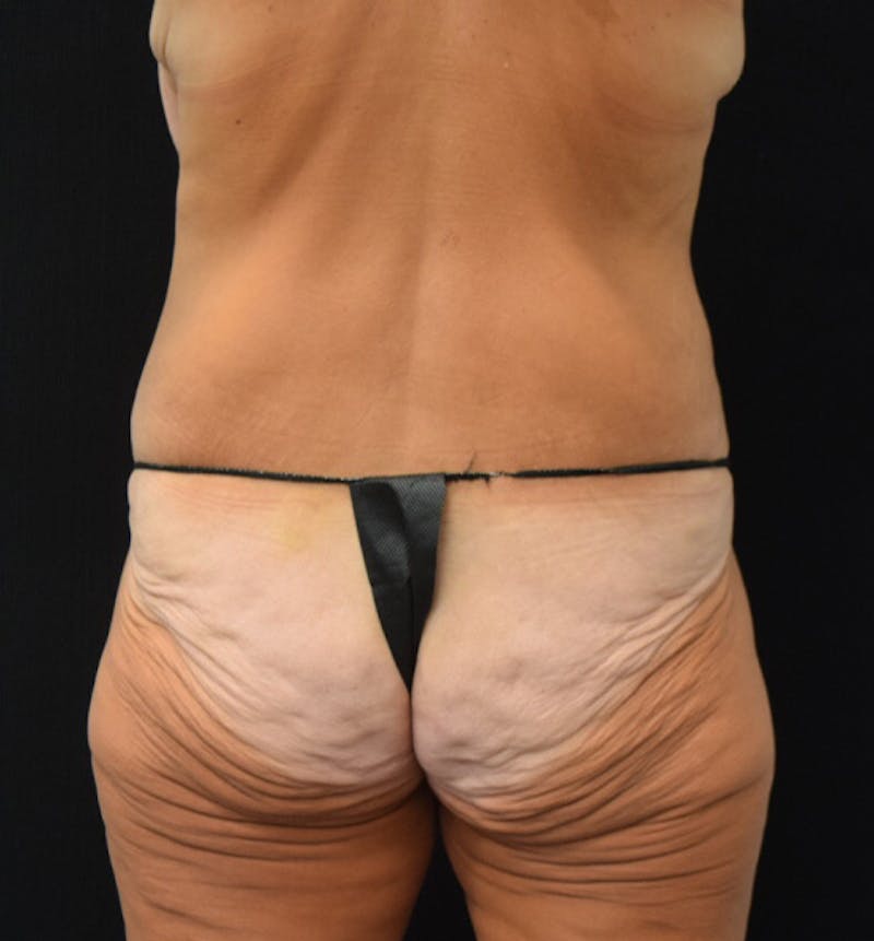 Lower Body Lift Before & After Gallery - Patient 102449350 - Image 11