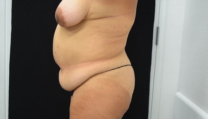 Abdominoplasty Before & After Gallery - Patient 102457120 - Image 5