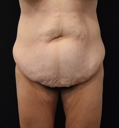 Lower Body Lift Before & After Gallery - Patient 102457116 - Image 1