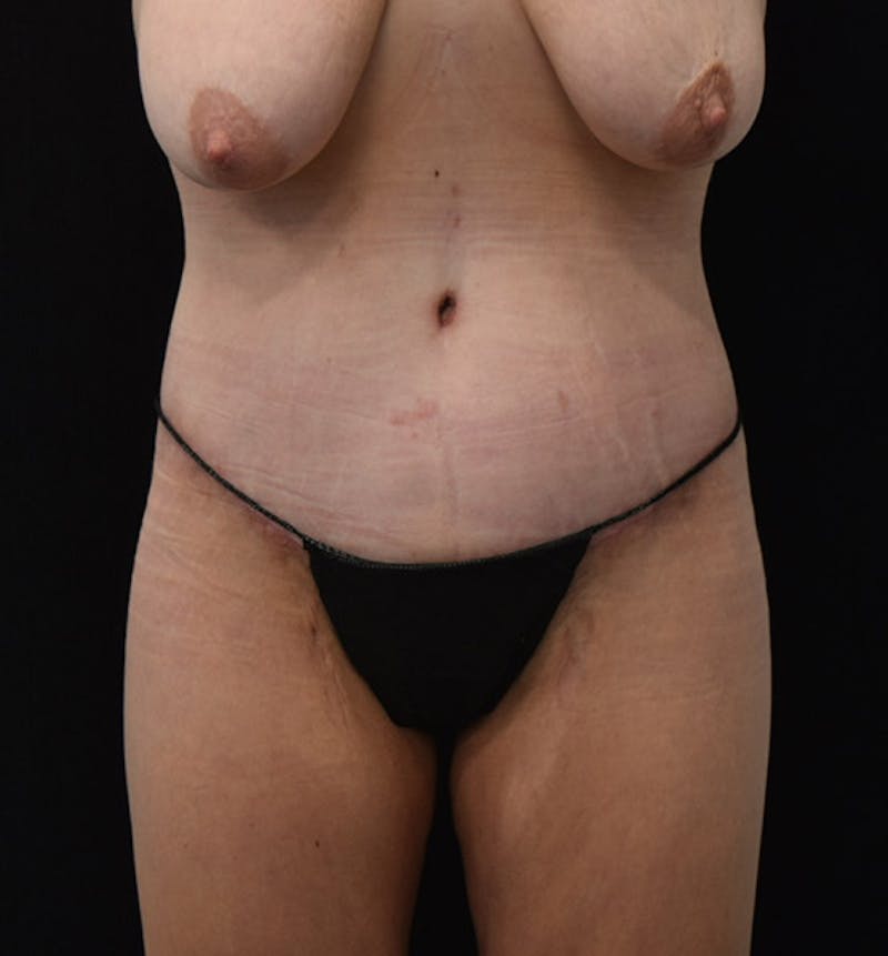 Lower Body Lift Before & After Gallery - Patient 102457116 - Image 2